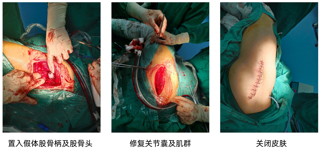 首例！ 自体骨深低温储存技术成功应用，骨缺损修复迎来新突破
