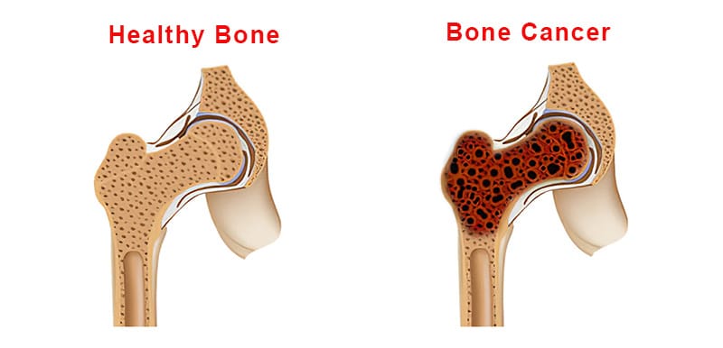 bone-cancer.jpg