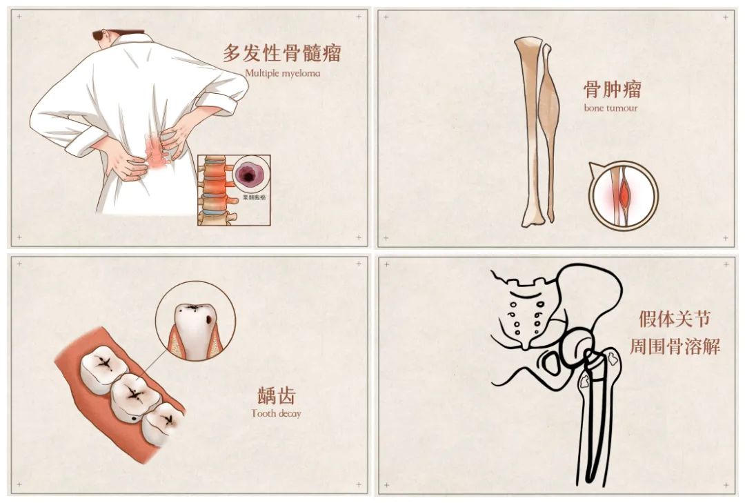 骨修复2.jpg