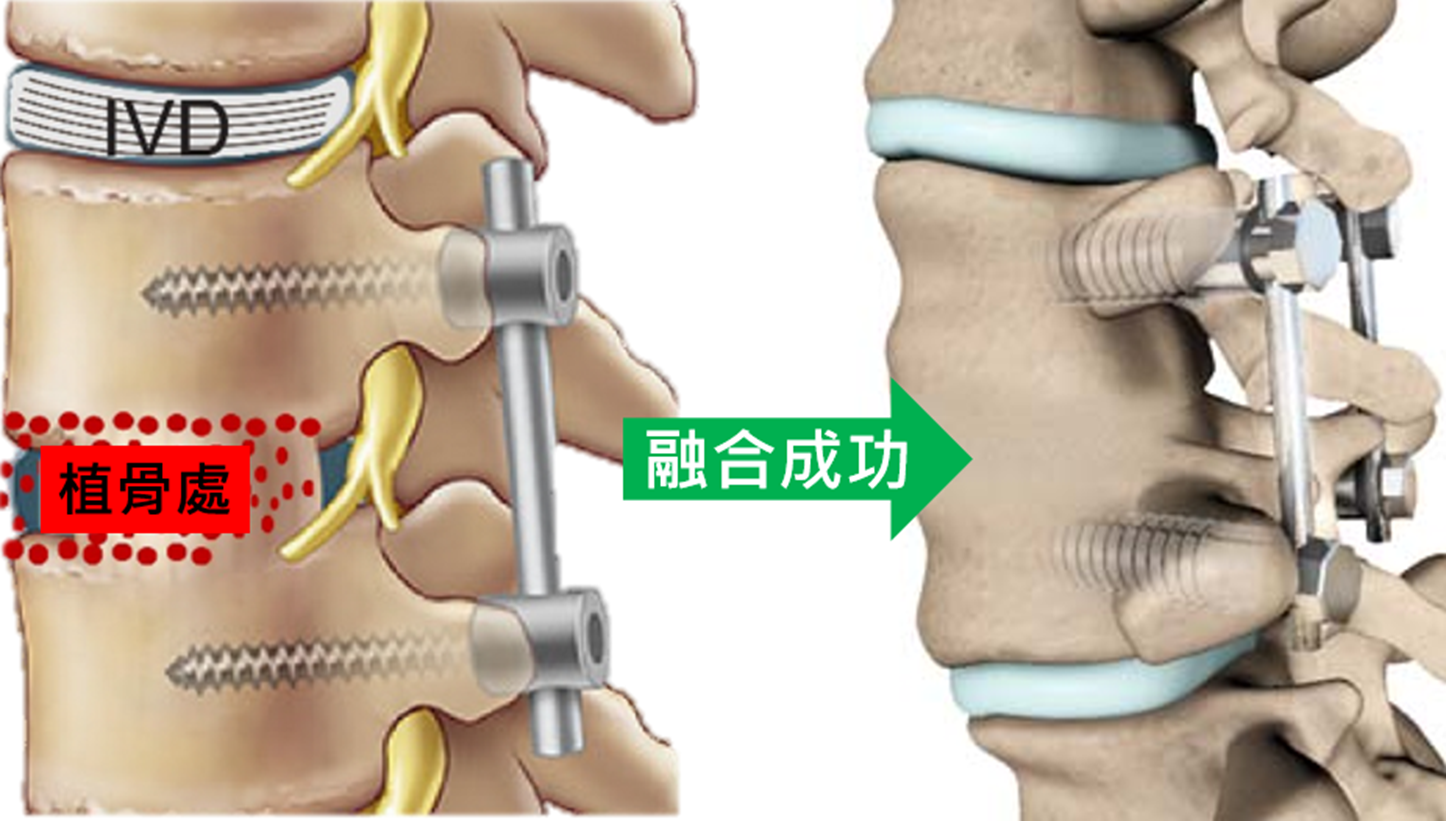 脊柱融合.png