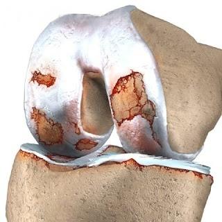 knee_osteoarth_intro01.jpg