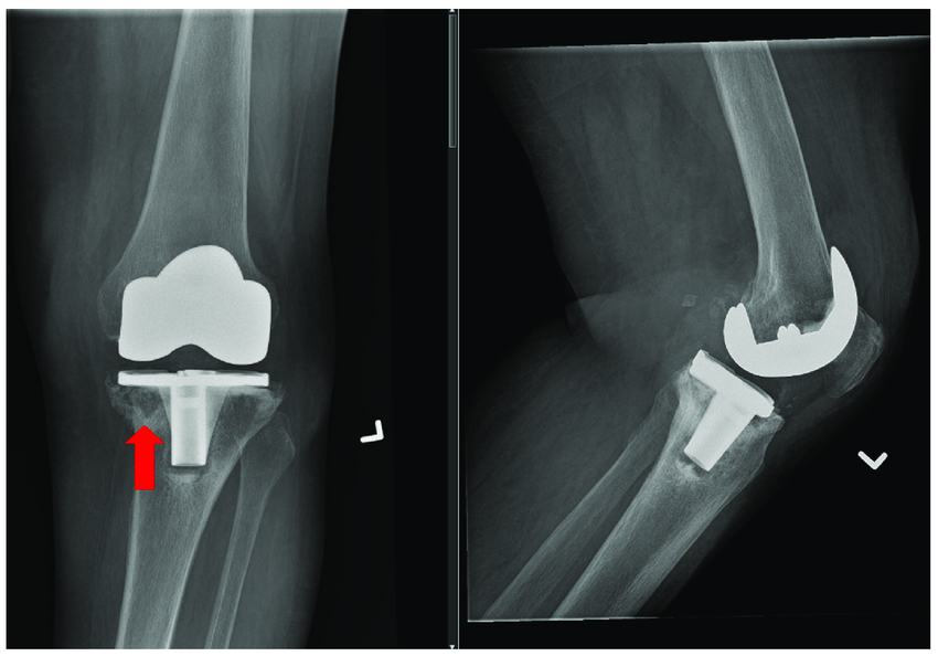 Radiographic-appearance-of-osteolysis-in-the-anteroposterior-AP-and-lateral-radiographs.png