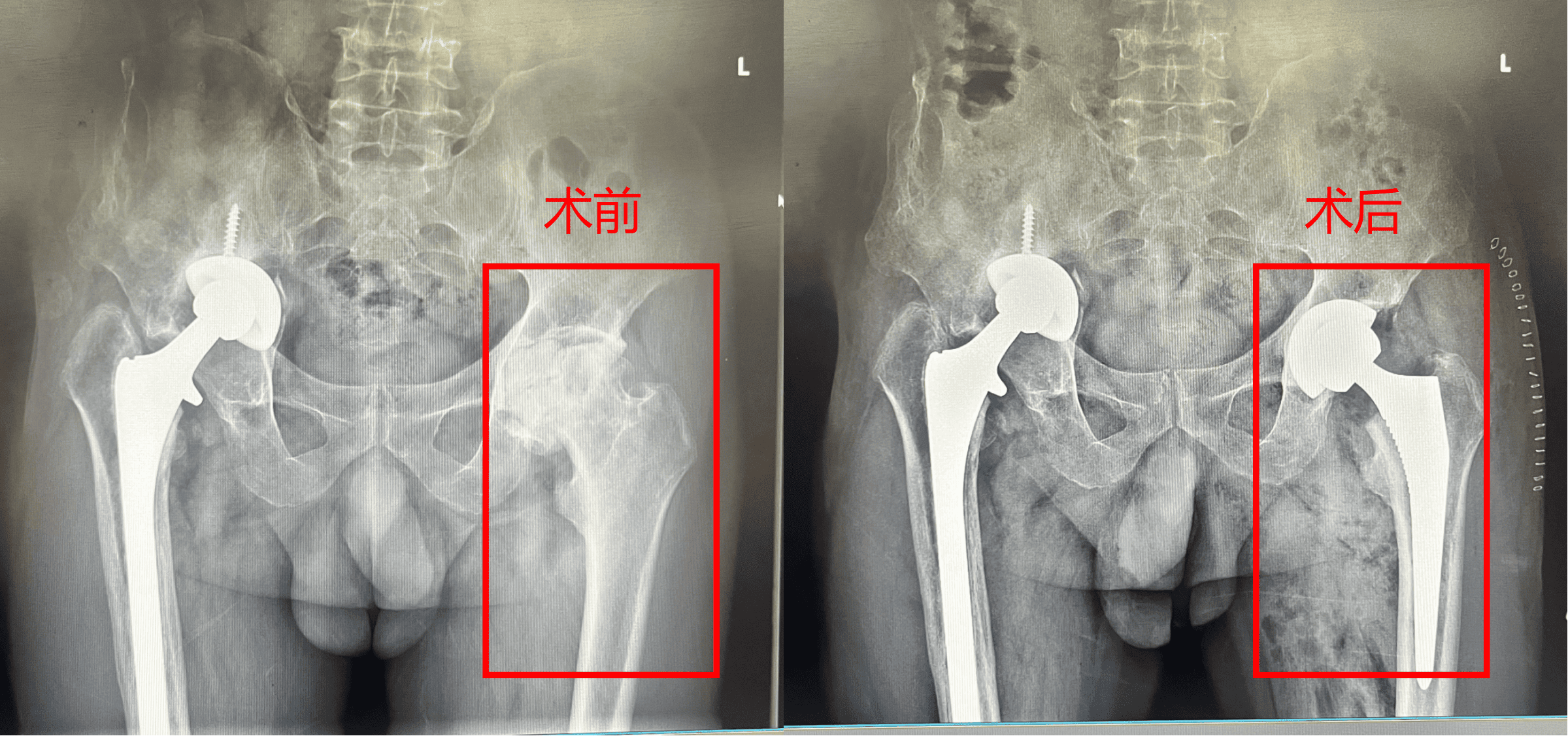 左侧全髋关节置换术前术后.png
